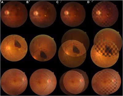 Color fundus photograph registration based on feature and intensity for longitudinal evaluation of diabetic retinopathy progression